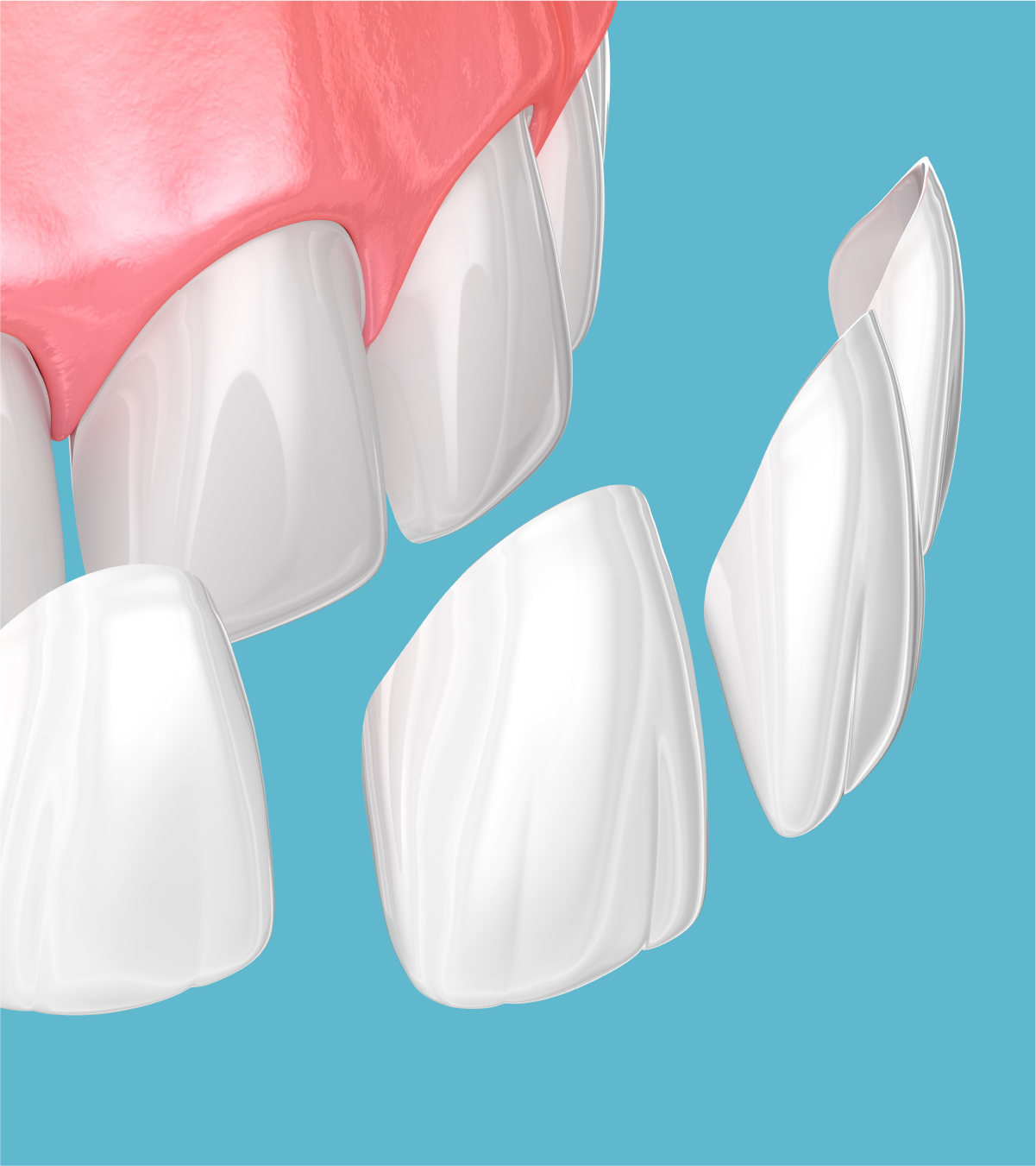 What Are Dental Crowns?